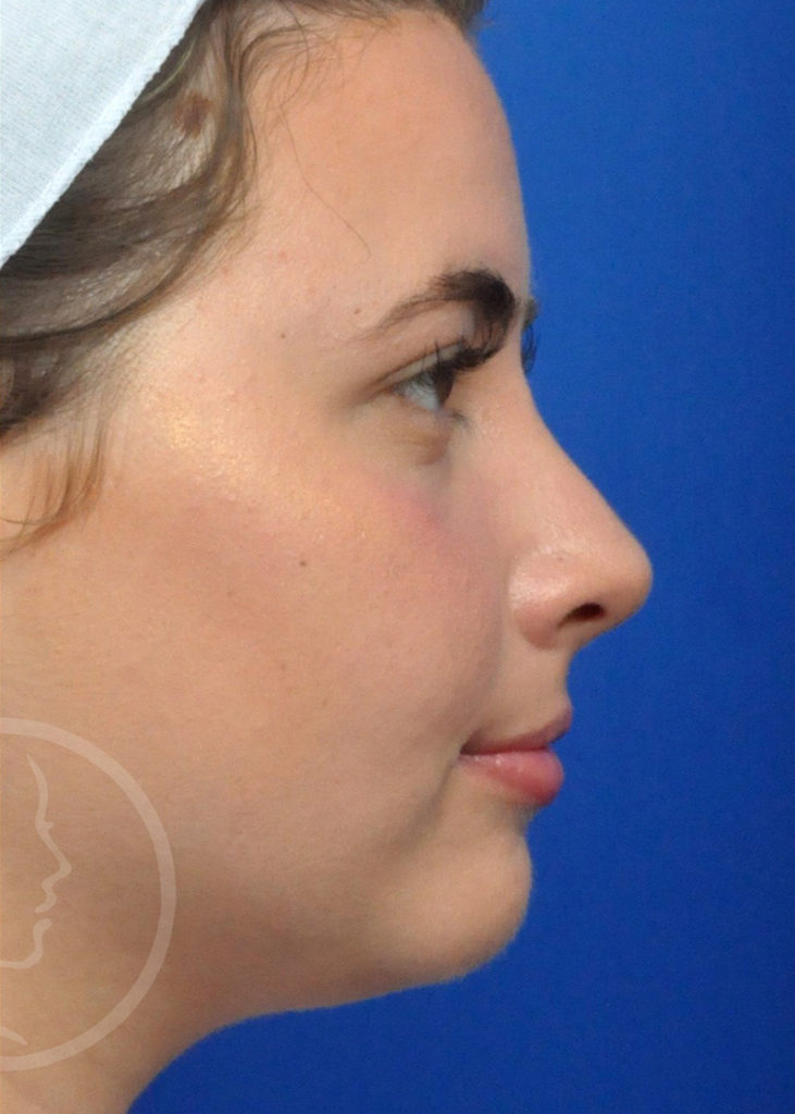 Rhinoplasty Before and After Pictures Jacksonville, FL