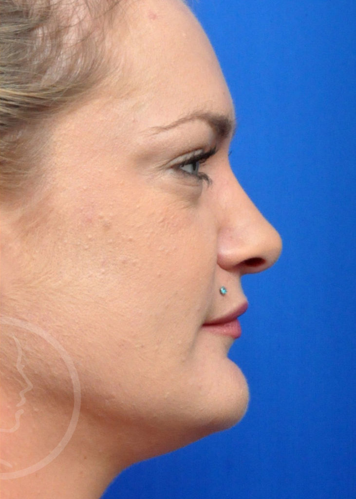 Rhinoplasty Before and After Pictures Jacksonville, FL