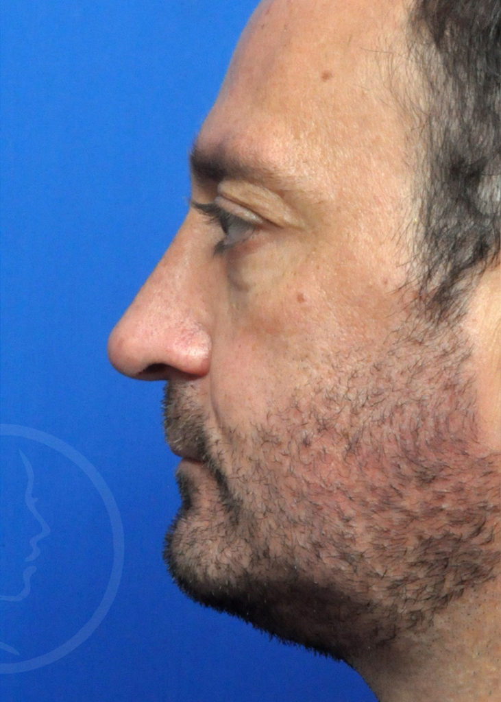 Rhinoplasty Before and After Pictures Jacksonville, FL