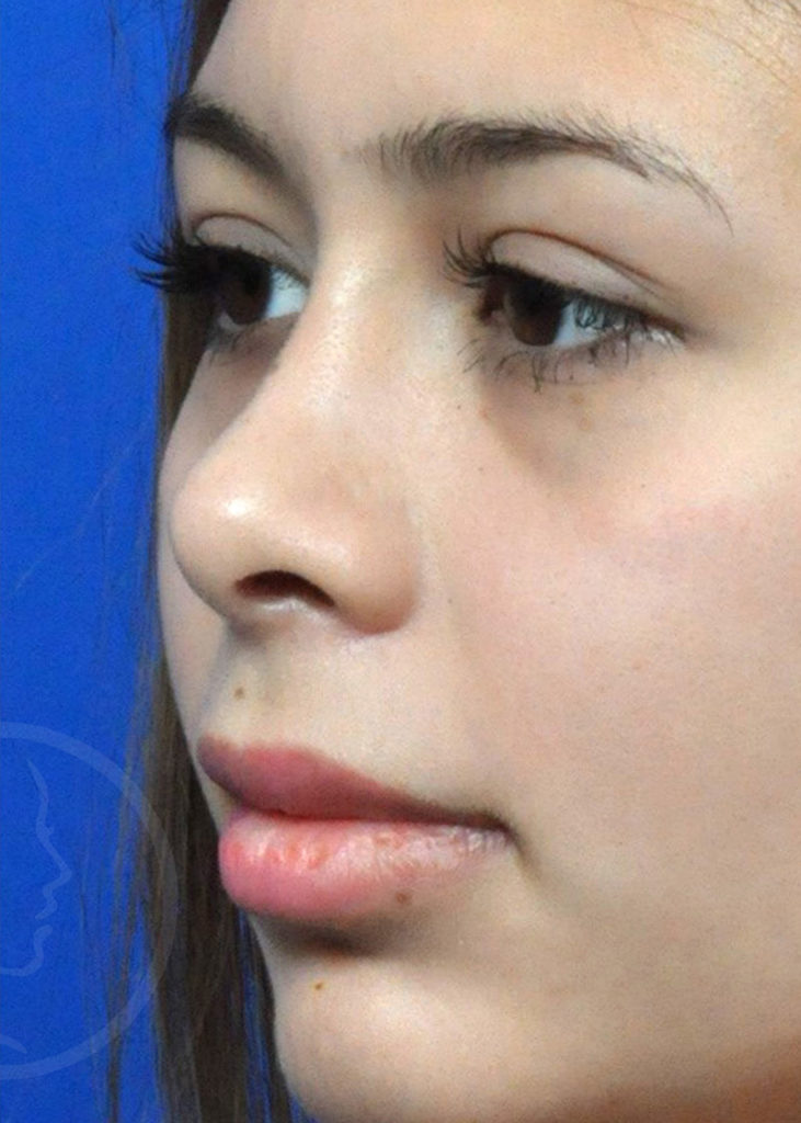 Rhinoplasty Before and After Pictures Jacksonville, FL