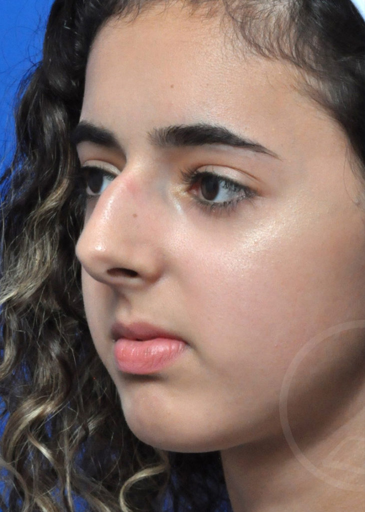 Rhinoplasty Before and After Pictures Jacksonville, FL