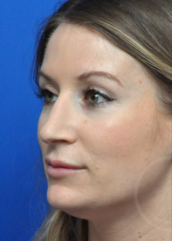 Rhinoplasty Before and After Pictures Jacksonville, FL