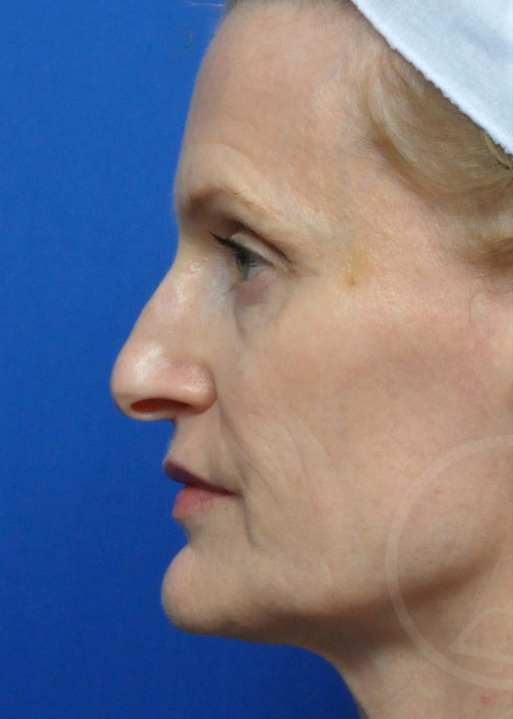 Rhinoplasty Before and After Pictures Jacksonville, FL