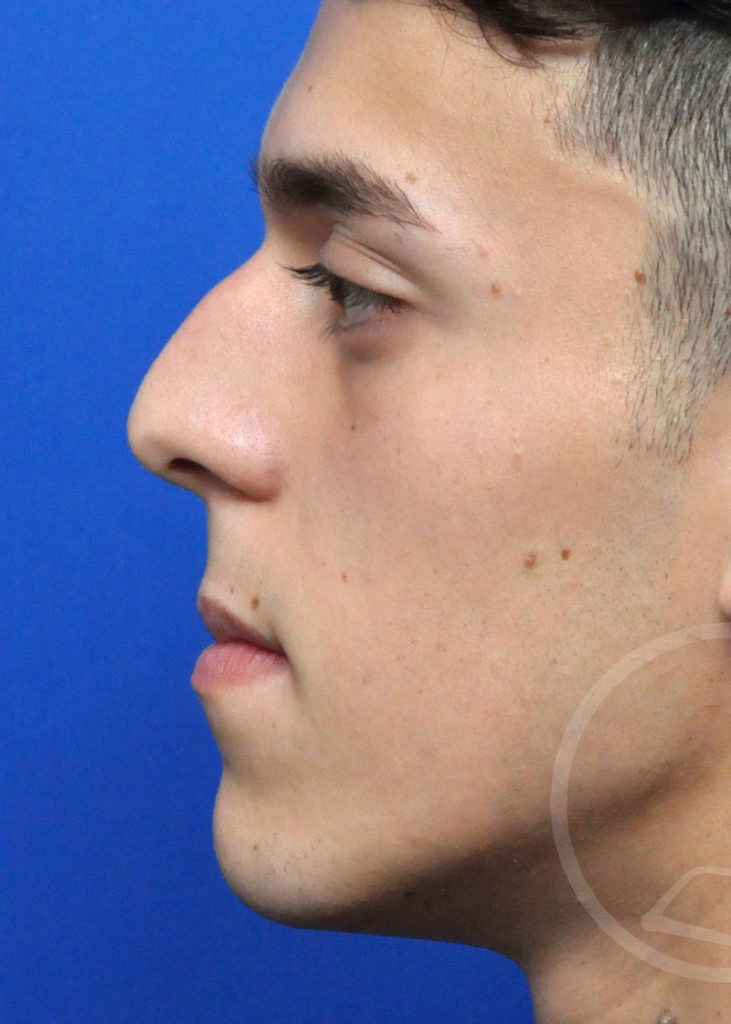 Rhinoplasty Before and After Pictures Jacksonville, FL