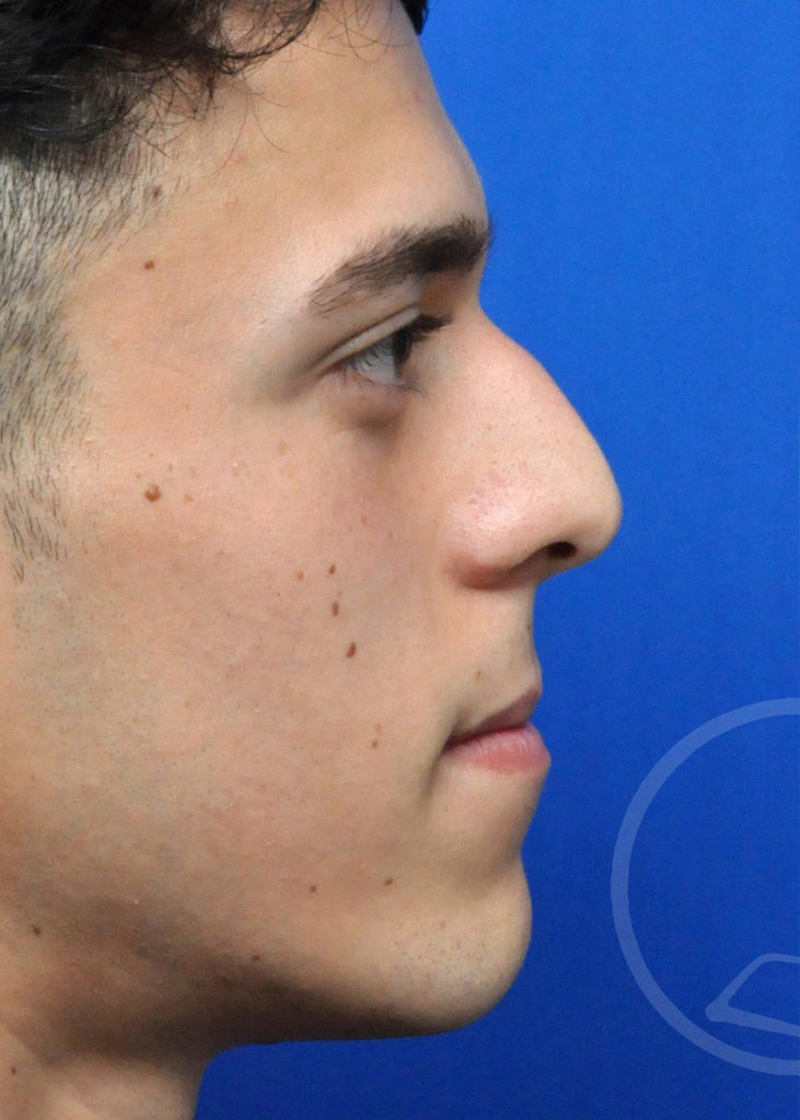 Rhinoplasty Before and After Pictures Jacksonville, FL