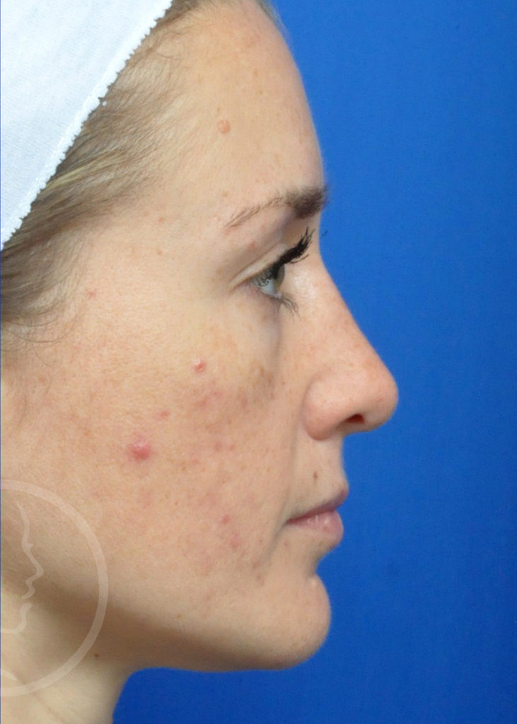 Rhinoplasty Before and After Pictures Jacksonville, FL