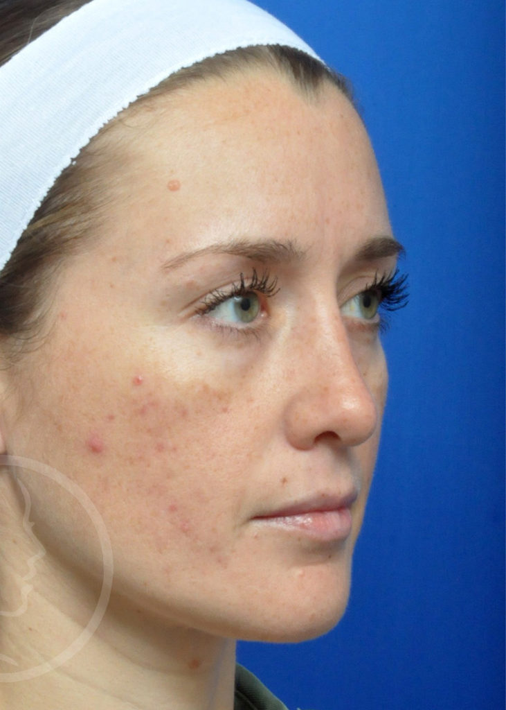 Rhinoplasty Before and After Pictures Jacksonville, FL