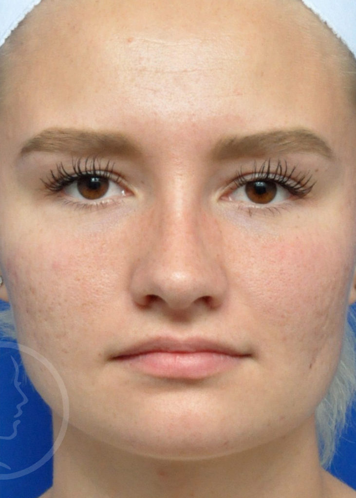 Rhinoplasty Before and After Pictures Jacksonville, FL