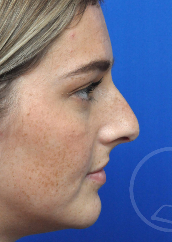 Rhinoplasty Before and After Pictures Jacksonville, FL