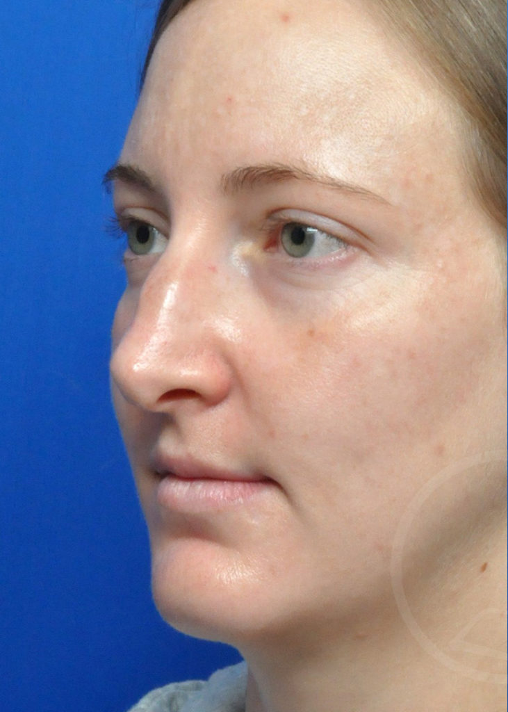 Rhinoplasty Before and After Pictures Jacksonville, FL