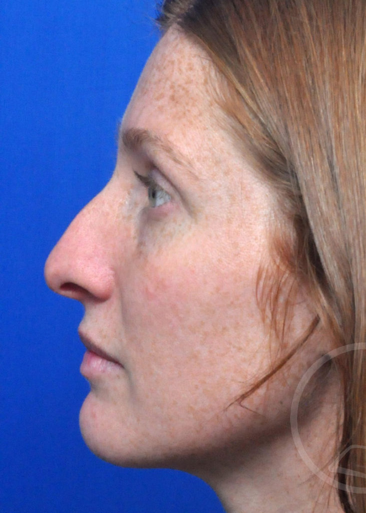 Rhinoplasty Before and After Pictures Jacksonville, FL