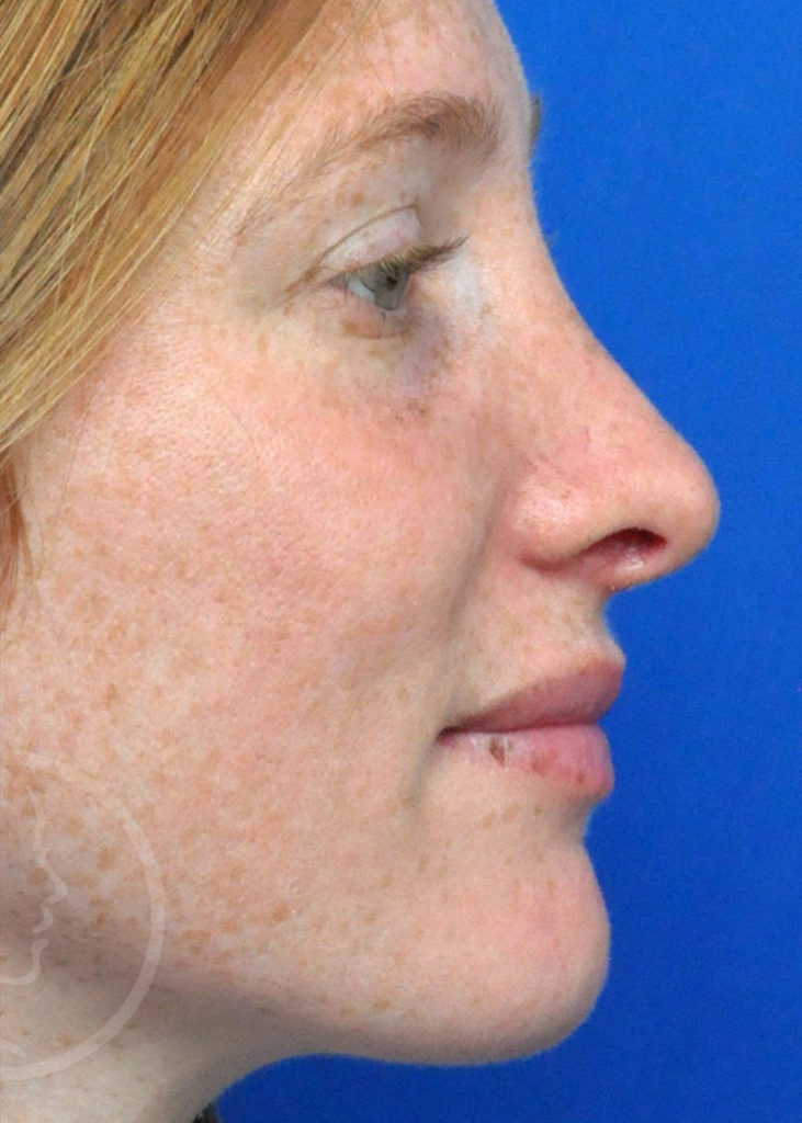 Rhinoplasty Before and After Pictures Jacksonville, FL