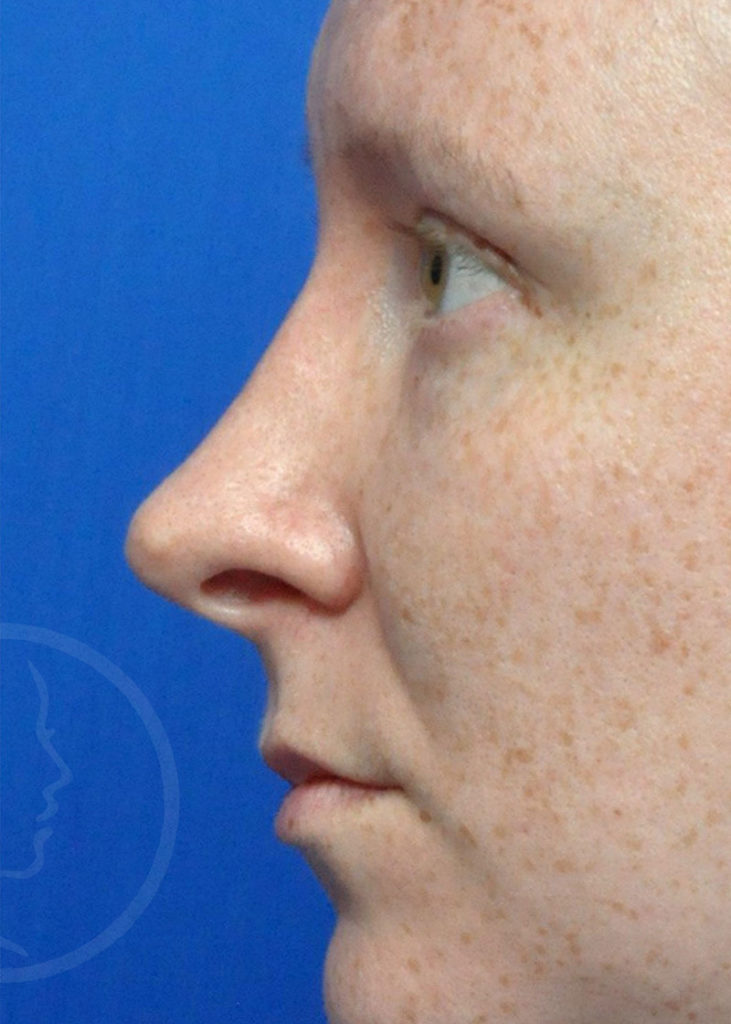 Rhinoplasty Before and After Pictures Jacksonville, FL