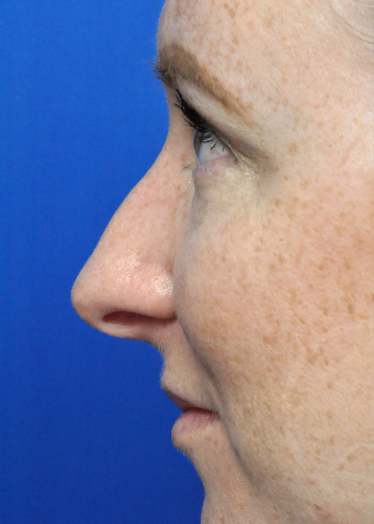 Rhinoplasty Before and After Pictures Jacksonville, FL