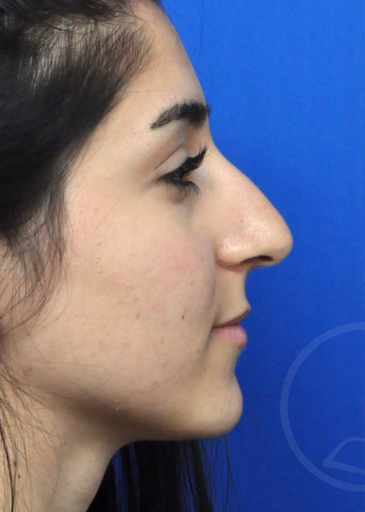 Rhinoplasty Before and After Pictures Jacksonville, FL