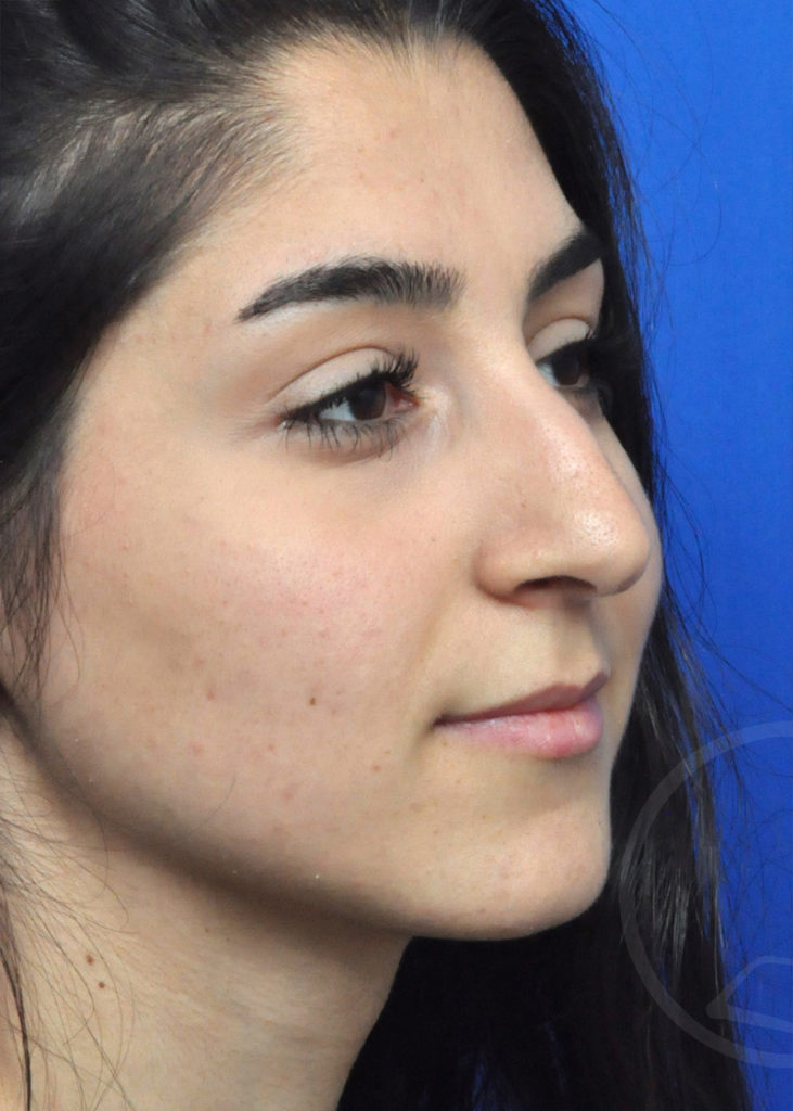 Rhinoplasty Before and After Pictures Jacksonville, FL