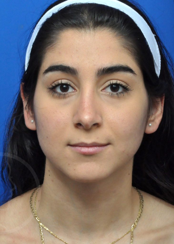 Rhinoplasty Before and After Pictures Jacksonville, FL