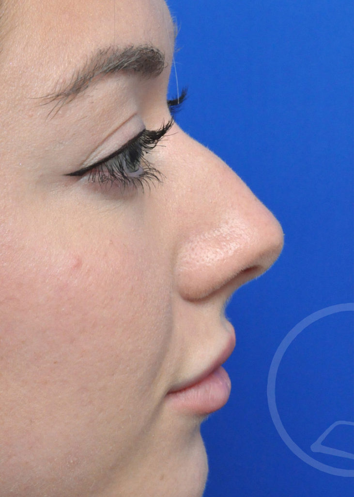 Rhinoplasty Before and After Pictures Jacksonville, FL