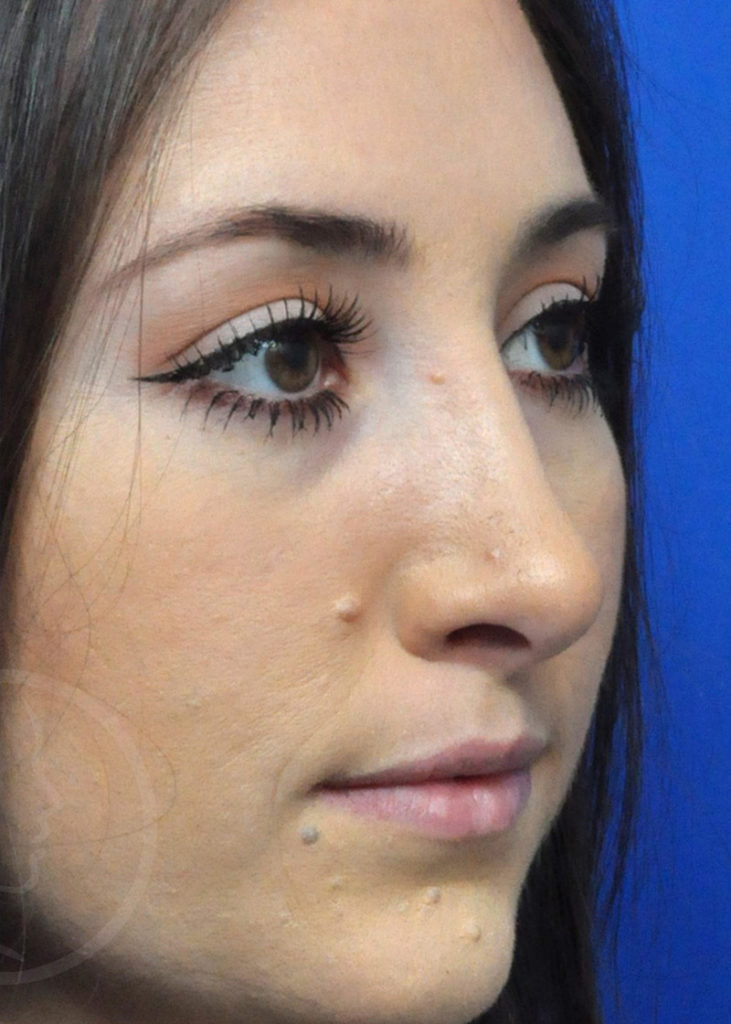 Rhinoplasty Before and After Pictures Jacksonville, FL