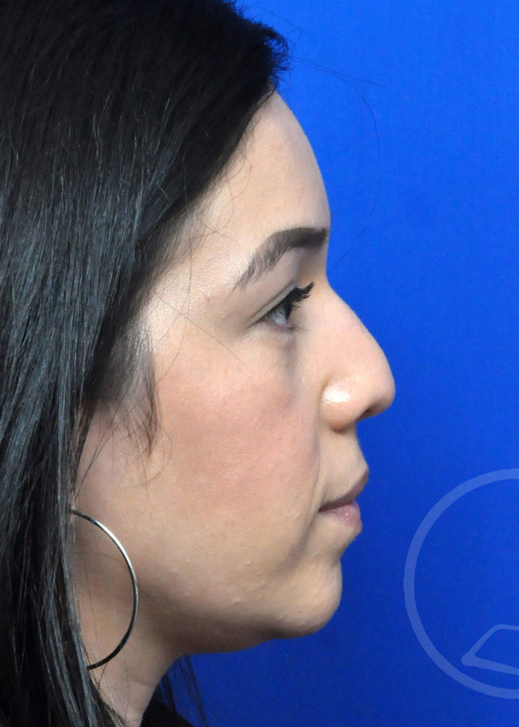 Rhinoplasty Before and After Pictures Jacksonville, FL