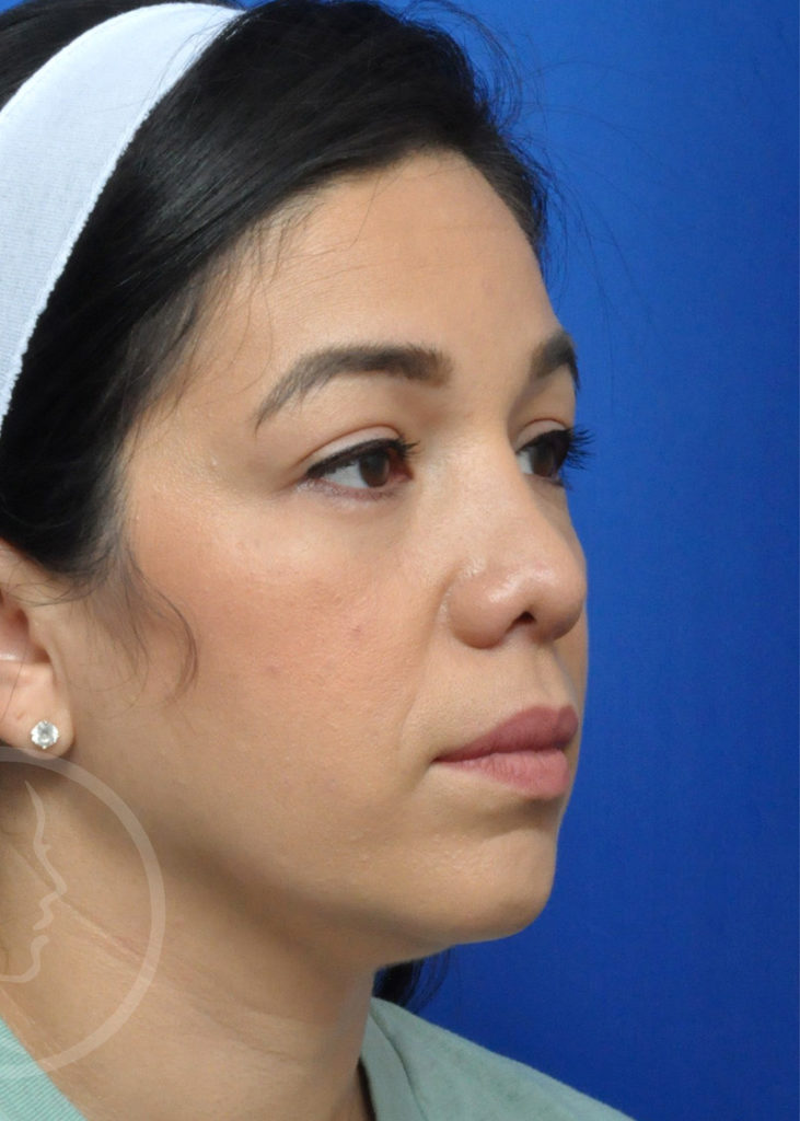 Rhinoplasty Before and After Pictures Jacksonville, FL