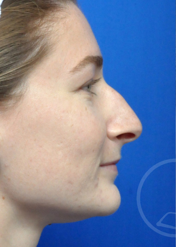 Rhinoplasty Before and After Pictures Jacksonville, FL