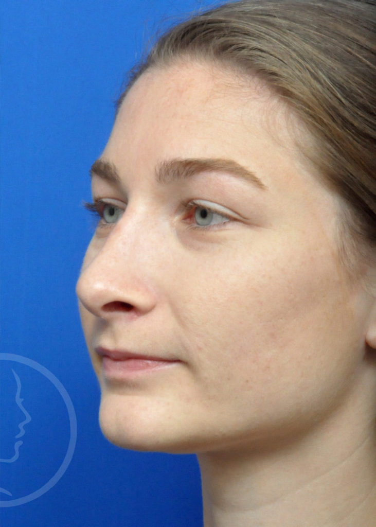 Rhinoplasty Before and After Pictures Jacksonville, FL