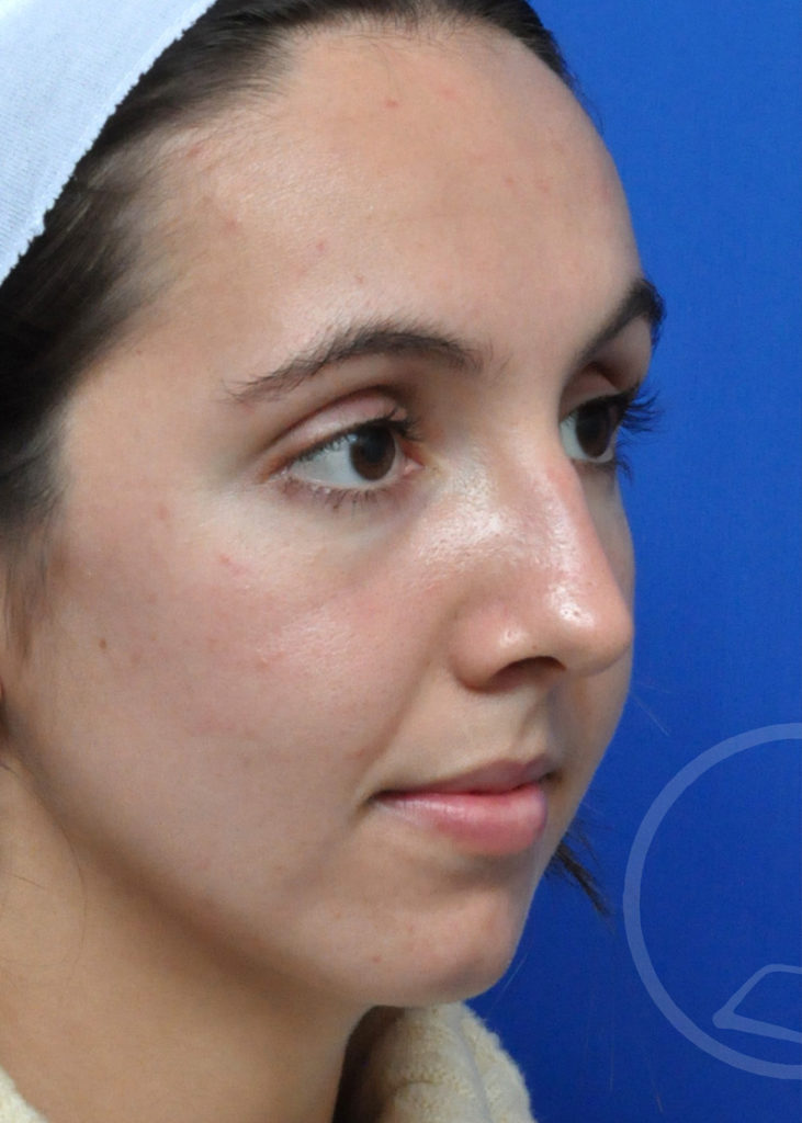 Rhinoplasty Before and After Pictures Jacksonville, FL