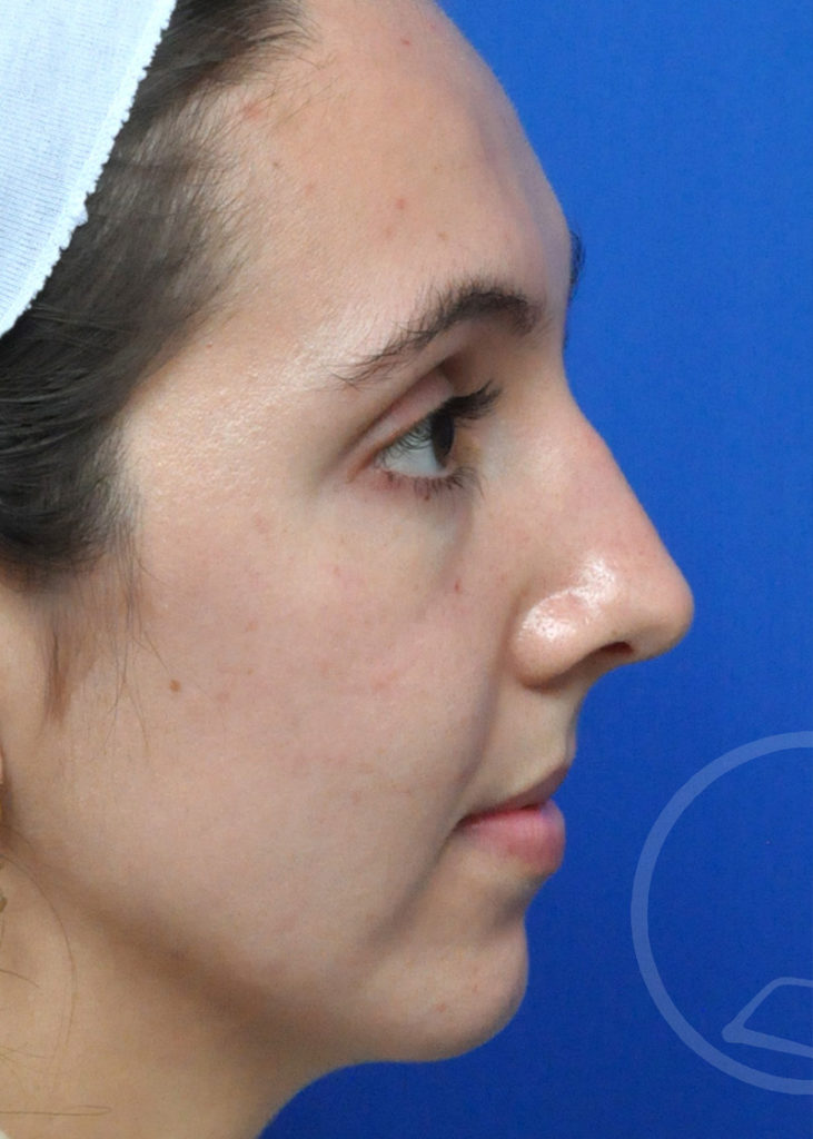 Rhinoplasty Before and After Pictures Jacksonville, FL