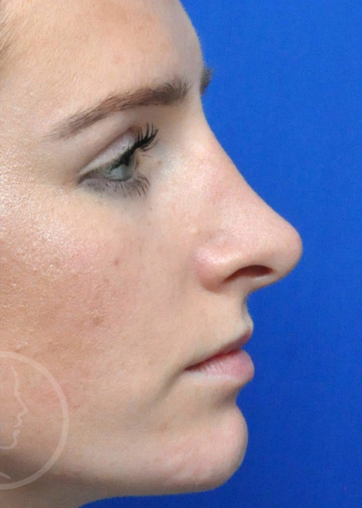 Rhinoplasty Before and After Pictures Jacksonville, FL