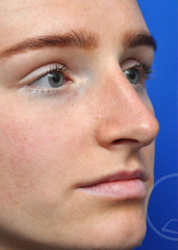 Rhinoplasty Before and After Pictures Jacksonville, FL