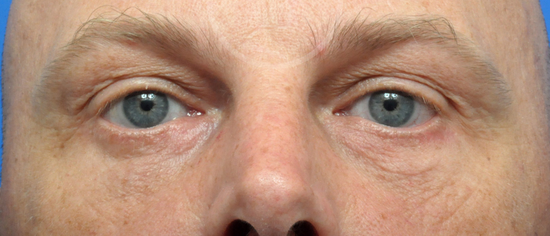 Blepharoplasty Before and After Pictures Jacksonville, FL