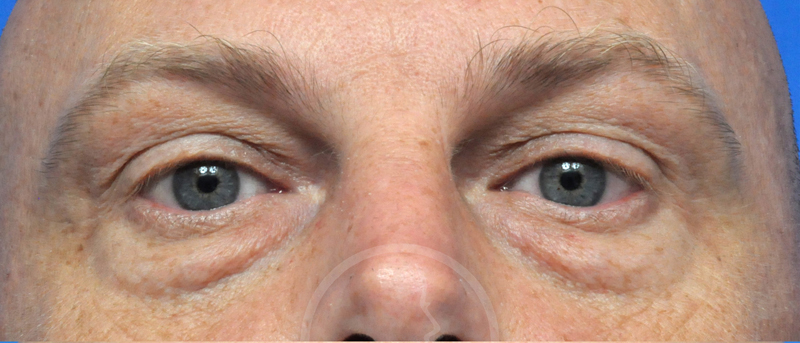 Blepharoplasty Before and After Pictures Jacksonville, FL