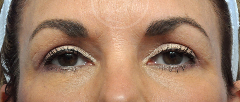 Blepharoplasty Before and After Pictures Jacksonville, FL