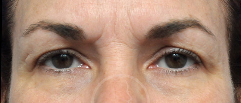 Blepharoplasty Before and After Pictures Jacksonville, FL