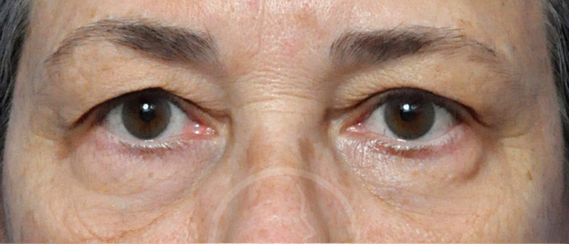 Blepharoplasty Before and After Pictures Jacksonville, FL