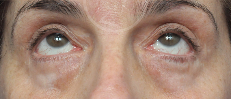 Blepharoplasty Before and After Pictures Jacksonville, FL