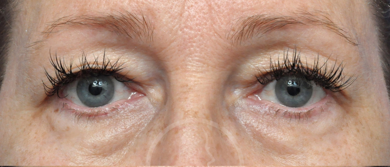 Blepharoplasty Before and After Pictures Jacksonville, FL