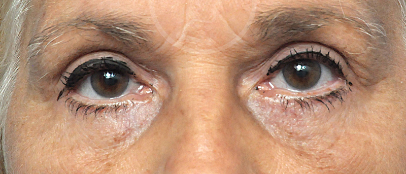 Blepharoplasty Before and After Pictures Jacksonville, FL