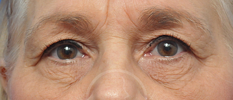 Blepharoplasty Before and After Pictures Jacksonville, FL