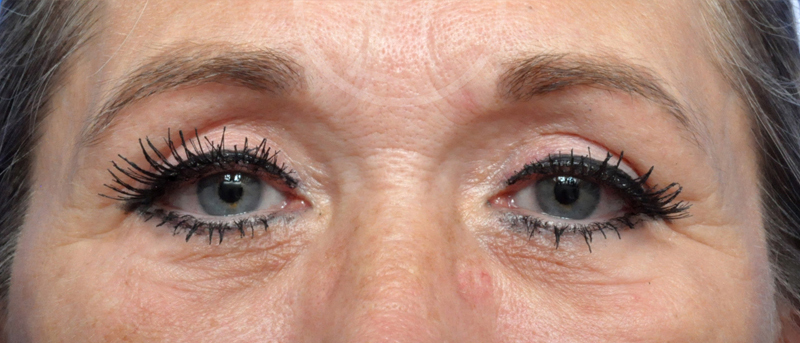 Blepharoplasty Before and After Pictures Jacksonville, FL