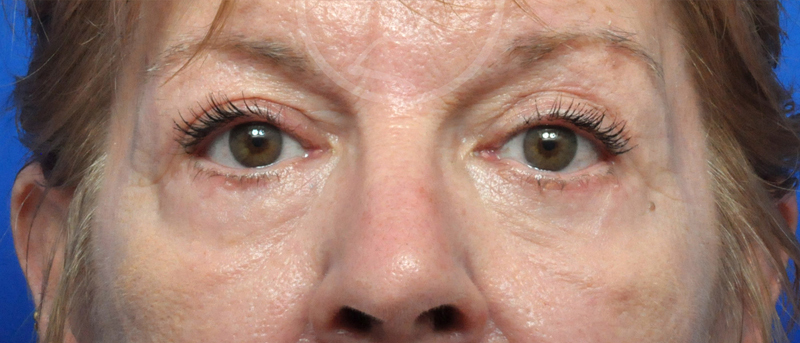 Blepharoplasty Before and After Pictures Jacksonville, FL