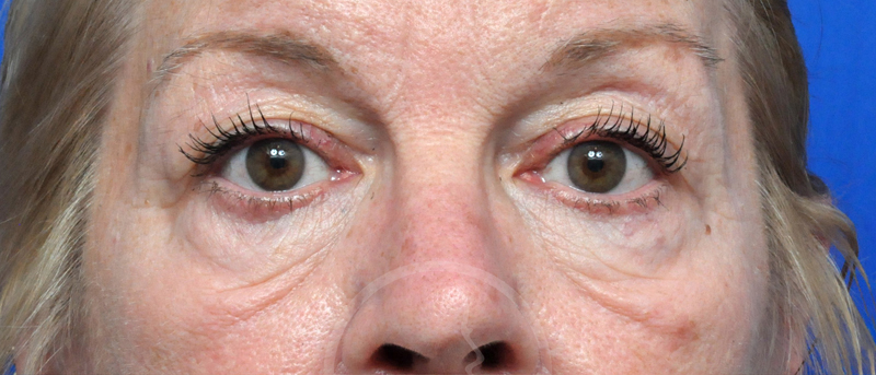 Blepharoplasty Before and After Pictures Jacksonville, FL