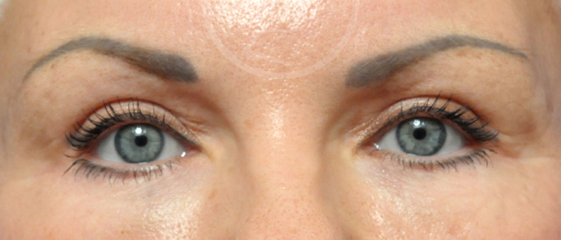 Blepharoplasty Before and After Pictures Jacksonville, FL