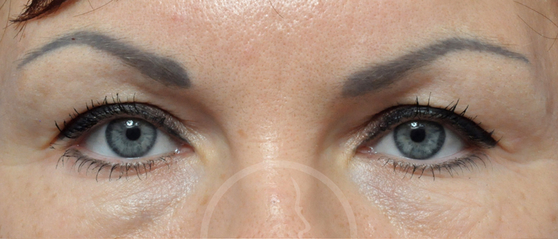 Blepharoplasty Before and After Pictures Jacksonville, FL