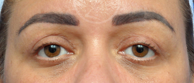 Blepharoplasty Before and After Pictures Jacksonville, FL