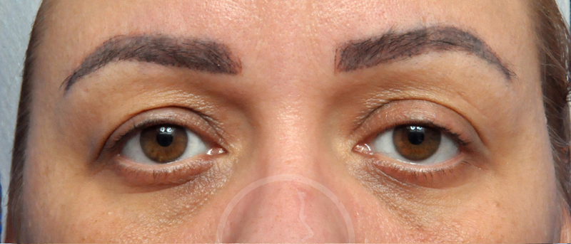 Blepharoplasty Before and After Pictures Jacksonville, FL