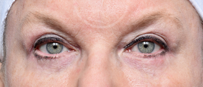 Blepharoplasty Before and After Pictures Jacksonville, FL