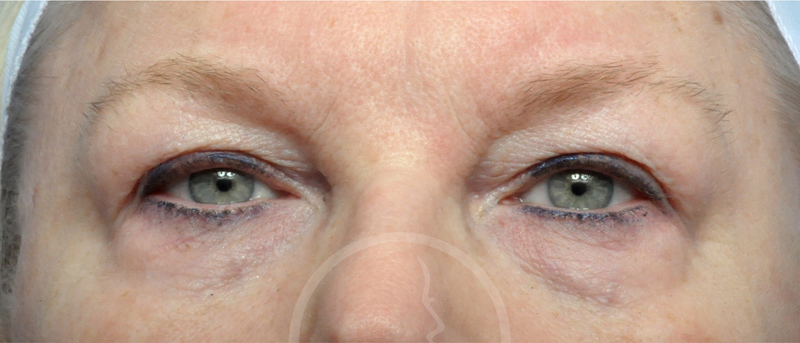 Blepharoplasty Before and After Pictures Jacksonville, FL