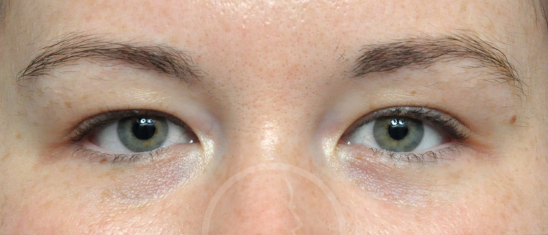 Blepharoplasty Before and After Pictures Jacksonville, FL